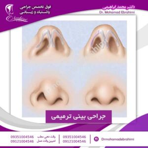 جراحی بینی ترمیمی - دکتر محمد ابراهیمی