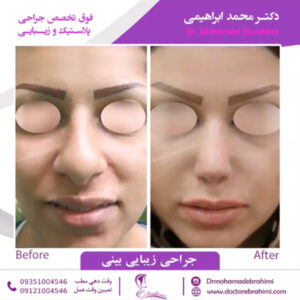 انواع روش های جراحی بینی - دکتر محمد ابراهیمی