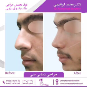 انواع روش های جراحی بینی - دکتر محمد ابراهیمی