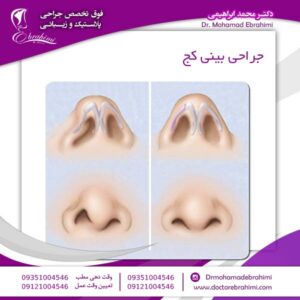 جراحی بینی کج - دکتر محمد ابراهیمی