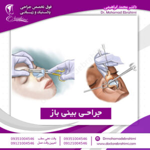 جراحی بینی باز - دکتر محمد ابراهیمی
