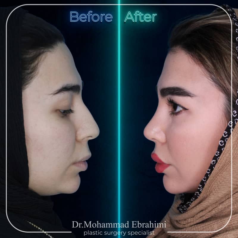 نمونه کار عمل بینی