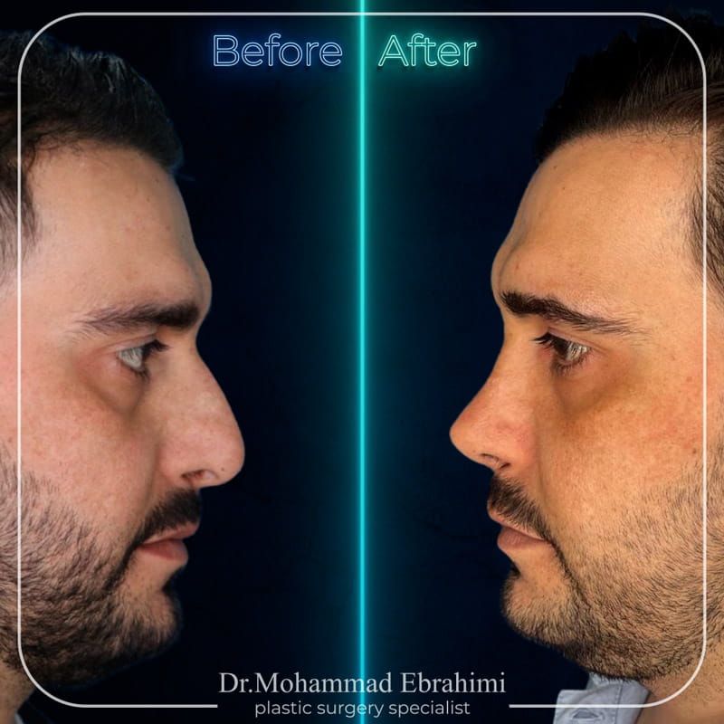 نمونه کار عمل بینی