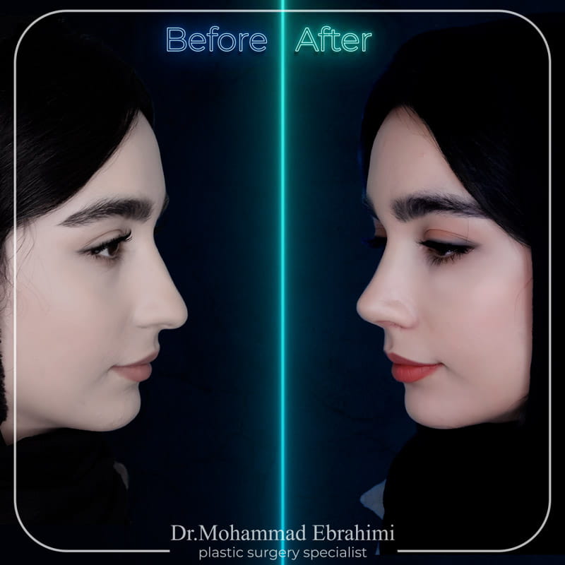 شنمونه کار عمل بینی