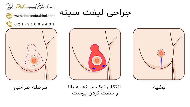 درمان افتادگی پستان