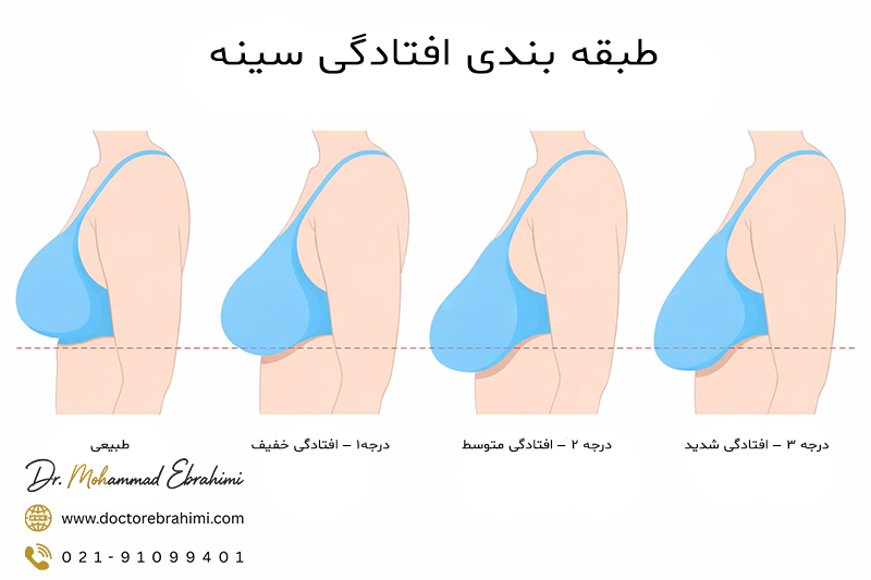 شل شدن سینه